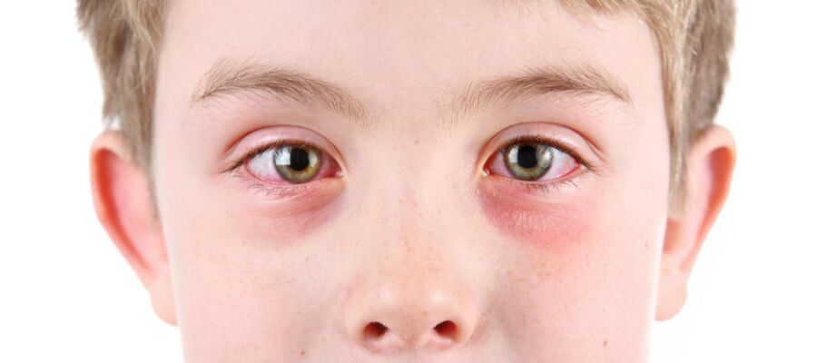 alergie ochi