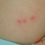 Alergia La Intepaturi De Insecte In Special Albina Si Viespe