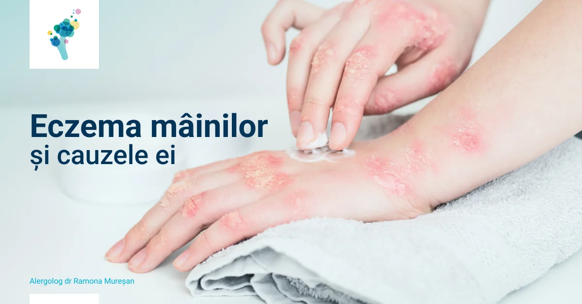 Eczema mainilor si cauzele ei - dr Ramona Muresan 1200px Eczema mainilor si cauzele ei - dr Ramona Muresan 1200px